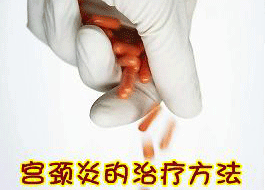 宫颈炎较佳治疗方法