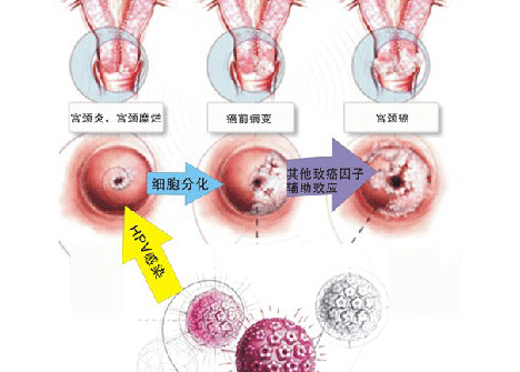 宫颈炎用药